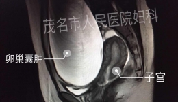 单孔腹腔镜手术让患者告别手术瘢痕