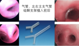 我院完成首例经硬质气管镜置入Y型硅酮支架手术