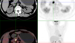 茂名一女士旅行前做了全身检查，万万没想到......