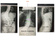 少年脊梁先天畸形愁愁愁，茂医骨科3-D打印技术巧助矫形妙妙妙