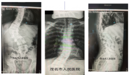 少年脊梁先天畸形愁愁愁，茂医骨科3-D打印技术巧助矫形妙妙妙
