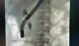 不开刀，胆管结石嘴里取——内镜技术ERCP