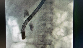 不开刀，胆管结石嘴里取——内镜技术ERCP