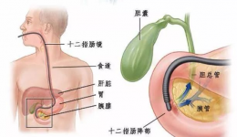 不必开刀！茂医专家妙手“口”中取石