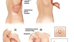 让患者重新拥有完美身体形象和自信笑容丨茂医乳腺科