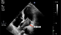 看茂医｜在心尖上“拆弹”！突破极限为超高龄患者重燃“心”生