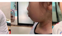 全国爱牙日丨用口呼吸，会变丑？