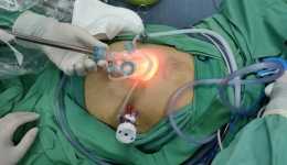 小切口完成大手术丨茂医胃肠外科二区技术新突破