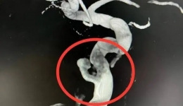 省医在身边有“医”靠丨仅20余例，专家合力救治罕见病患者，保住视力