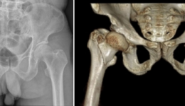 车祸患者严重骨折，茂医骨科机器人“巧手”辅助微创修复