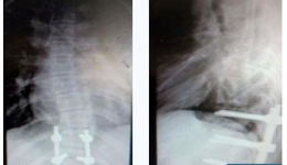 茂名少年脊柱先天“S形”17年，手术后终于“挺起脊梁”