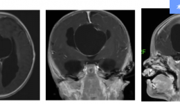 颅内“拆弹”｜患儿仅三个月大！茂医多学科协作，引流成功！