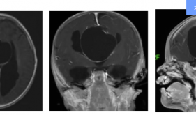 颅内“拆弹”｜患儿仅三个月大！茂医多学科协作，引流成功！