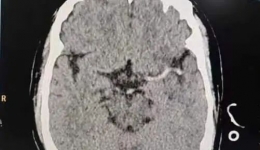 六旬大叔突发脑梗，专家紧急取栓救回一命!气温寒冷，医生重要提醒→