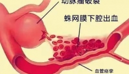 冬季头痛｜警惕脑动脉瘤破裂