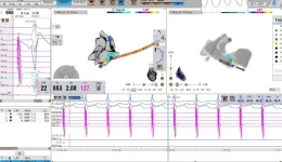 七旬老伯心率超200次/分钟，茂医一站式介入治疗解困