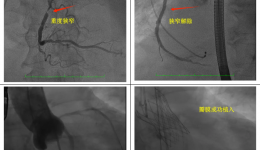 看茂医｜勇攀“心”高峰：一站式手术成效实现1+1>2