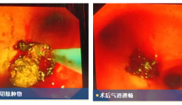 突然“咯血”！气管被堵！茂医MDT“软硬兼施”打通生命气道