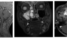 警惕！青少年频发鼻出血，幕后元凶竟可能是……