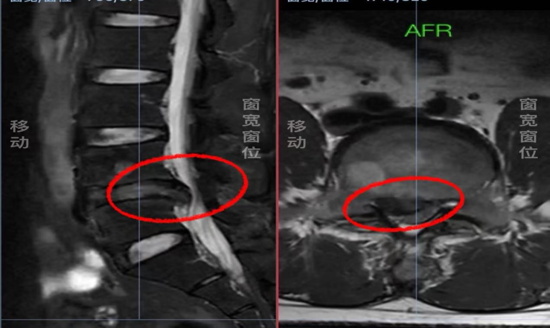 1.术前MRI影像巨大突出