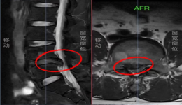 微创之光｜茂医脊柱外科：以微小切口解决患者腰椎间盘突出大问题