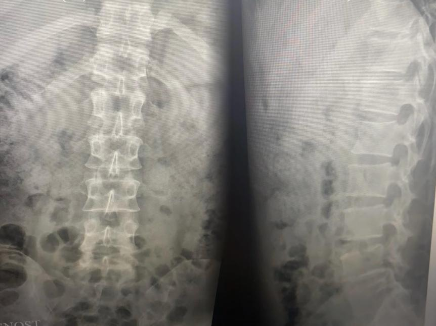 2.术后复查x线情况