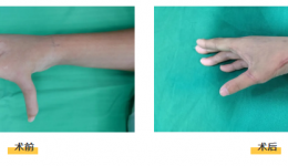 形像“蟹钳”，茂医专家提醒：这类畸形切勿错过黄金治疗时间