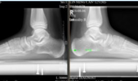 省医在茂名名医零距离| 小小“螺丝钉”，微创解决儿童扁平足“大问题”