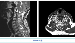 看茂医丨“镜”入佳境 茂名地区首例显微镜下脊柱手术获成功