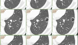 省医在茂名 名医零距离丨携手患者挑战两癌！专家强调：早筛早诊早治是关键