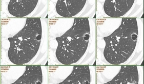 省医在茂名 名医零距离丨携手患者挑战两癌！专家强调：早筛早诊早治是关键