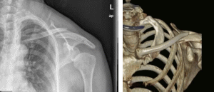 1.术前影像提示左锁骨中段斜行骨折