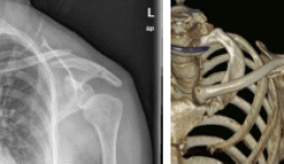 改善患者就医体验丨茂医“老朋友”骨科机器人助力手术切口“隐形”