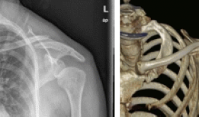 改善患者就医体验丨茂医“老朋友”骨科机器人助力手术切口“隐形”