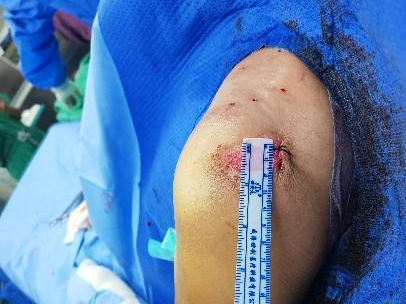 3.术后切口小,仅1cm