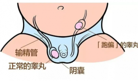 消失的“蛋蛋”？茂医专家提醒：“隐睾”切不可忽视