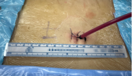 再添“镜”彩！脊柱外科二区完成茂医首例AUSS脊柱内镜手术