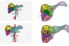 茂医首创“三转化治疗”战肝癌，将不可能变为可能！