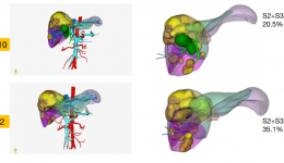 茂医首创“三转化治疗”战肝癌，将不可能变为可能！