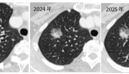 省医在茂名 名医零距离丨小结节差点变成“大问题”？专家提醒：定期复查很重要