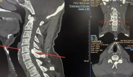 看茂医丨UBE微创技术助六旬老人重拾生活希望