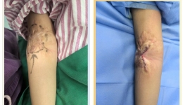 看茂医丨整形美容外科巧解瘢痕“枷锁”，“折翼”天使重展笑颜