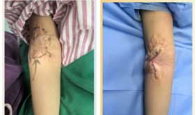 看茂医丨整形美容外科巧解瘢痕“枷锁”，“折翼”天使重展笑颜