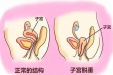 小科普大健康丨松弛、漏尿、脱垂…是盆底肌正在求救！