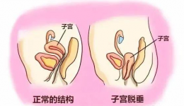 小科普大健康丨松弛、漏尿、脱垂…是盆底肌正在求救！