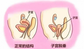 小科普大健康丨松弛、漏尿、脱垂…是盆底肌正在求救！