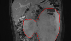 省医在茂名名医零距离丨专家联手拆除16岁少年腹腔“巨型炸弹”