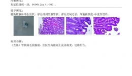 微创切出肿物竟是“癌前病变”？茂医专家：胃肠镜检查不可忽视