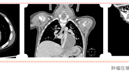 茂名专家妙手摘“拳” 微创切除4岁男童胸腔巨大肿瘤