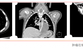 茂名专家妙手摘“拳” 微创切除4岁男童胸腔巨大肿瘤